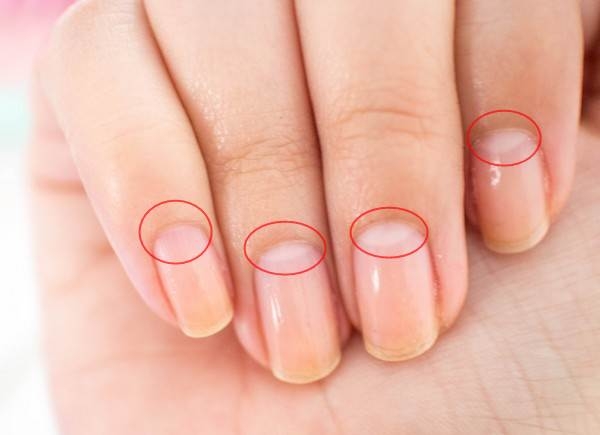 Nhận biết tình trạng sức khỏe qua phần lưỡi liềm màu trắng trên ngón tay